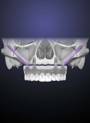 full-arch