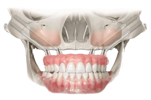 zygoma_implants